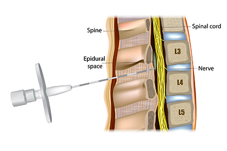 Diagram of the spine and spinal cord showing where the epidural tube enters your back and delivers medication.