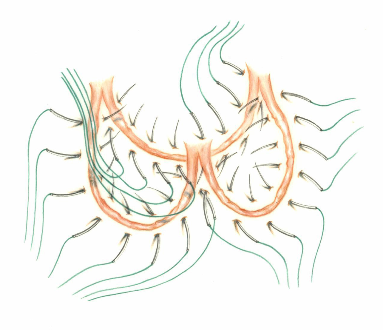 Color illustration demonstrates how to sew standard sutures for aortic valve replacement