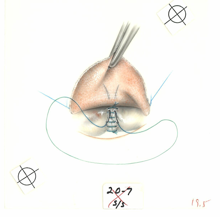 Color illustration of leaflets attached with a horizontal suture.   