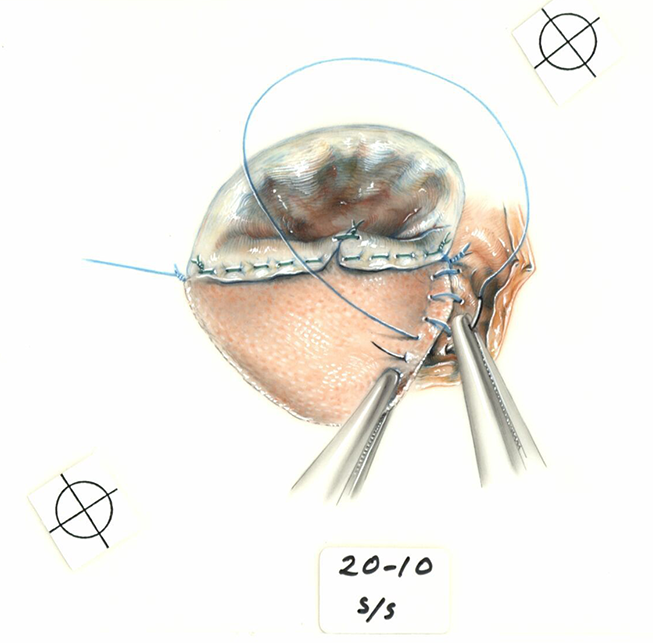 Color illustration of completed repair of the atrial portion. 