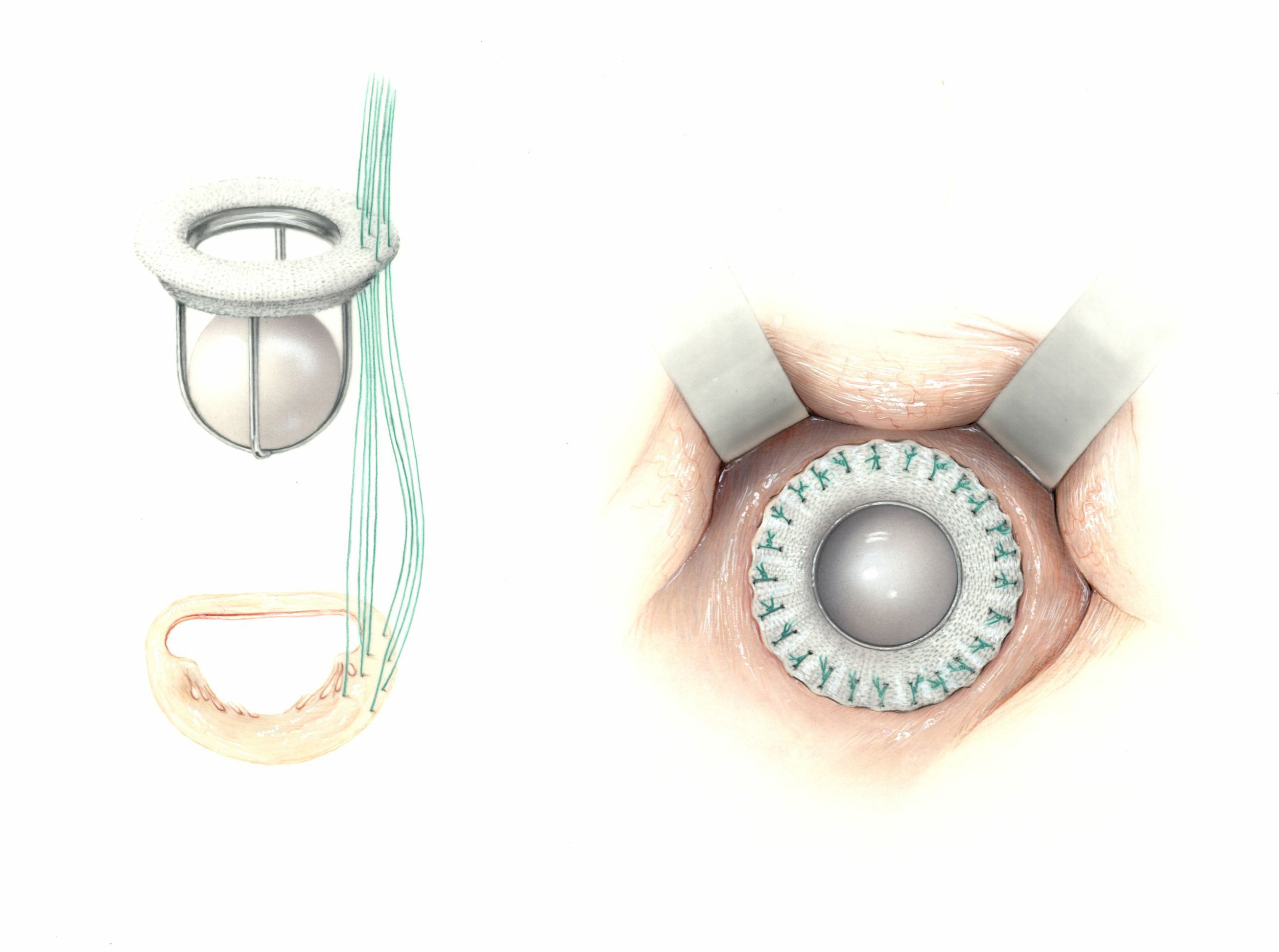 Illustration of Starr-Edwards heart valves from side and top view