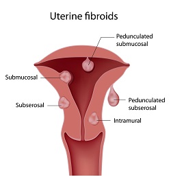 This graphic shows the different types of uterine fibroids and where they grow in the uterus.