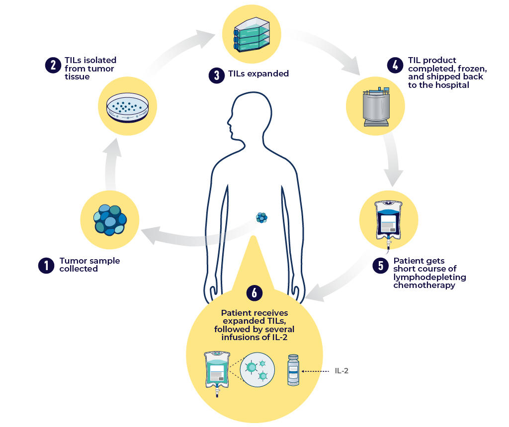 Infographic shows the steps of TIL therapy: collecting a tumor sample, isolating TILs, expanding TILs, chemotherapy, and giving the TILs back to the patient.