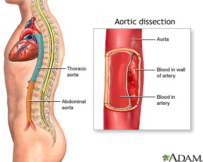 An Aortic Dissection