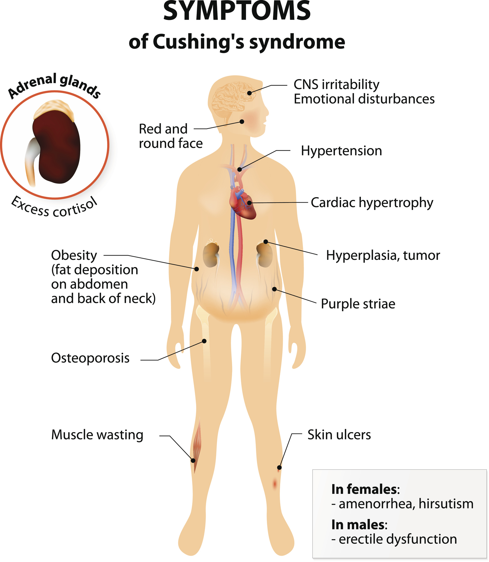 Cushing Disease / Cushing Syndrome | Brain Institute | OHSU