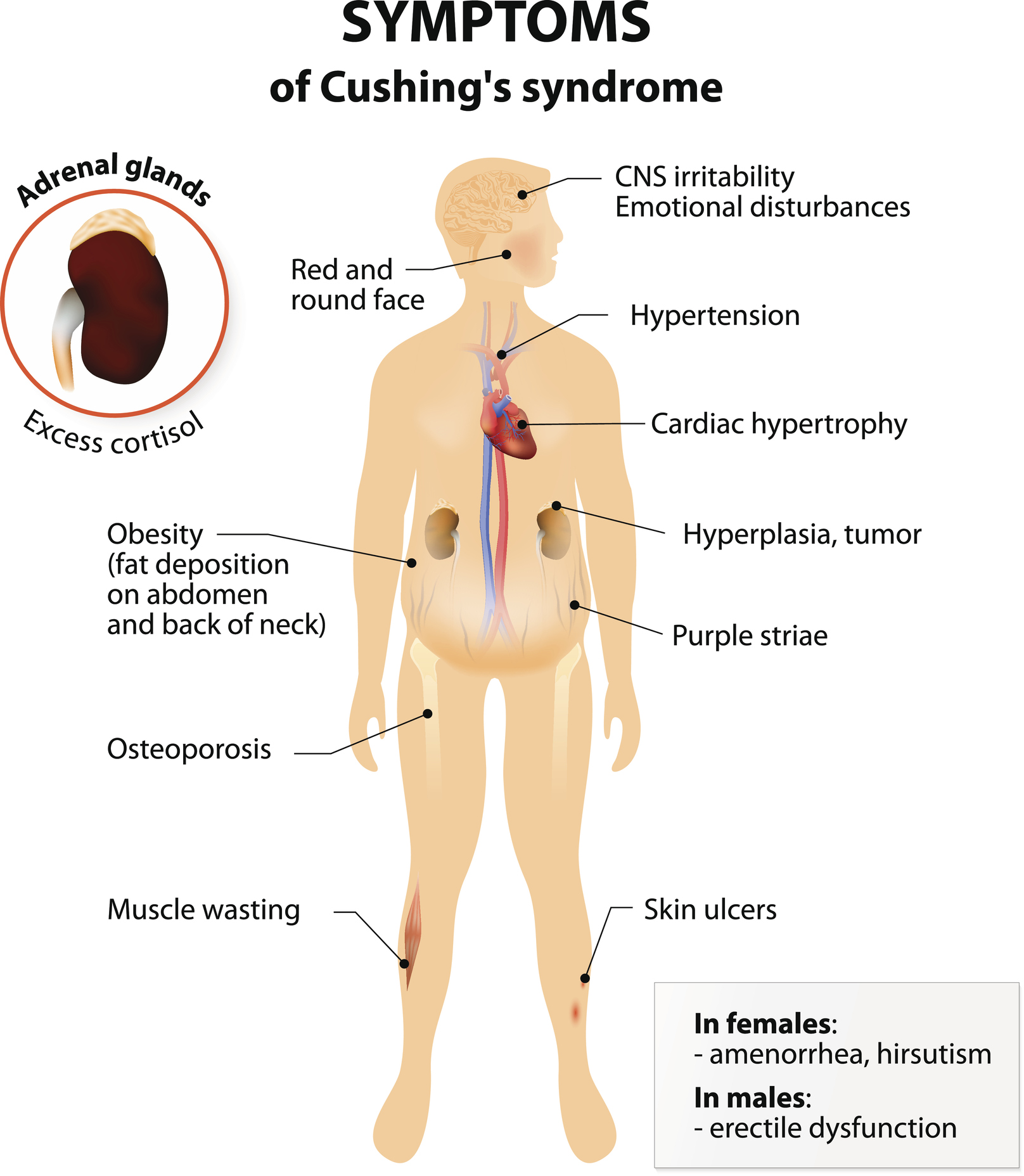 Cushing Disease