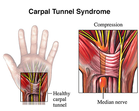 carpal tunnel numb hand