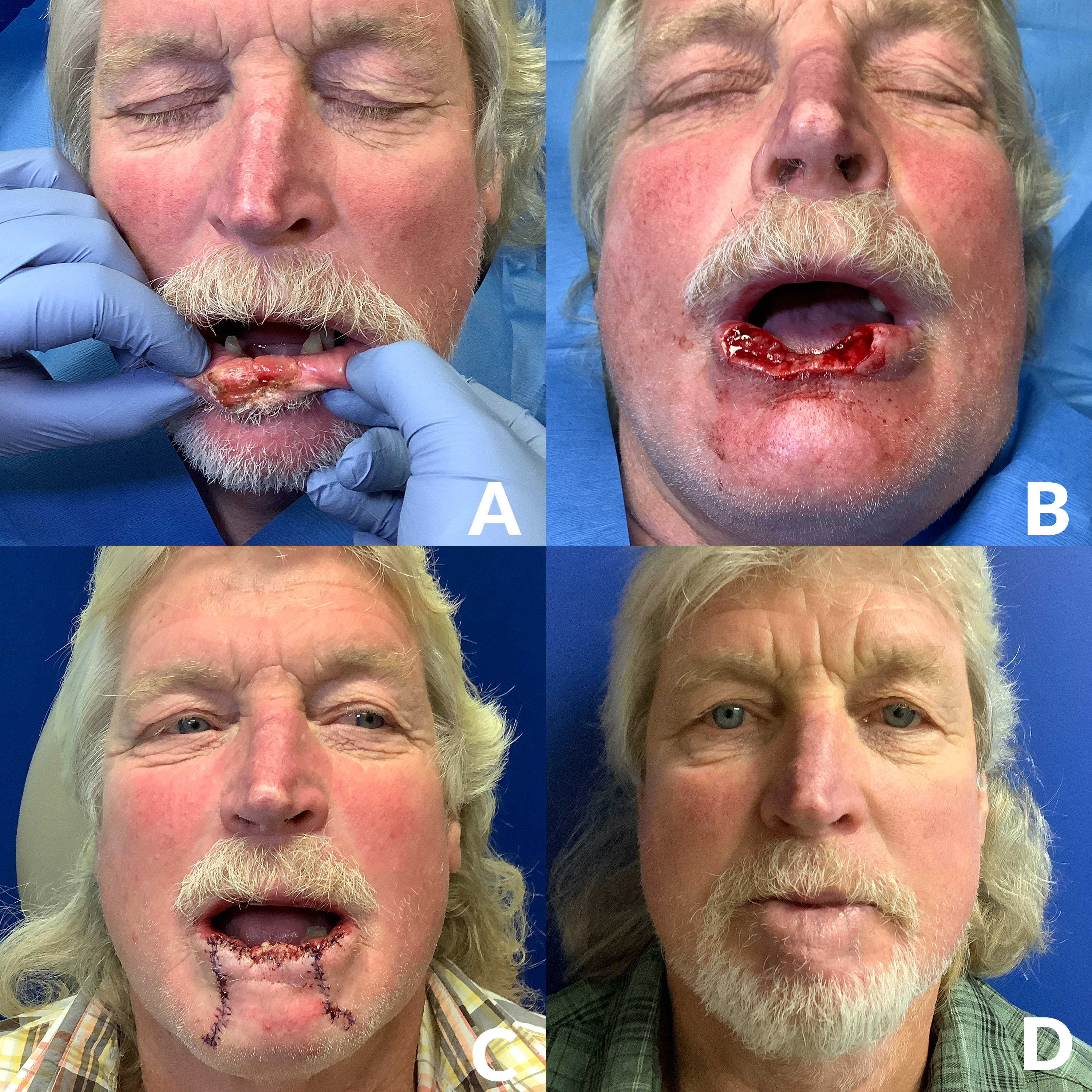 A surgical patient with four images, each in its own stage of the surgery and healing process