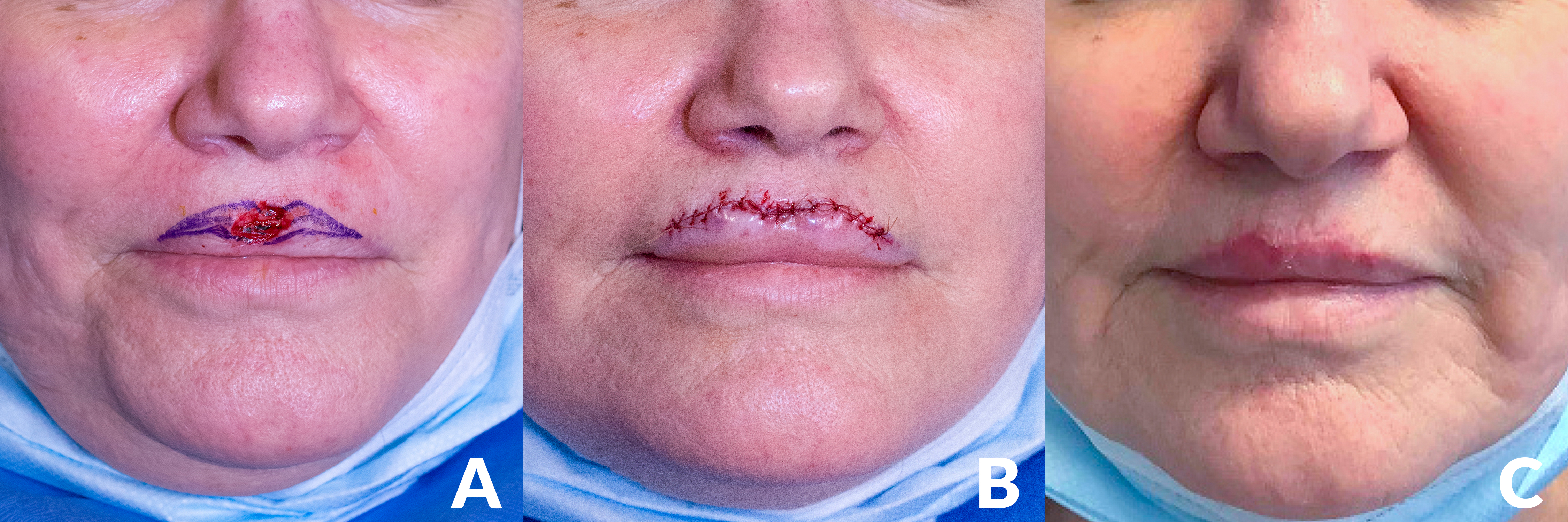 A surgical patient with three images, showing the progression of their skin cancer surgery and reconstruction