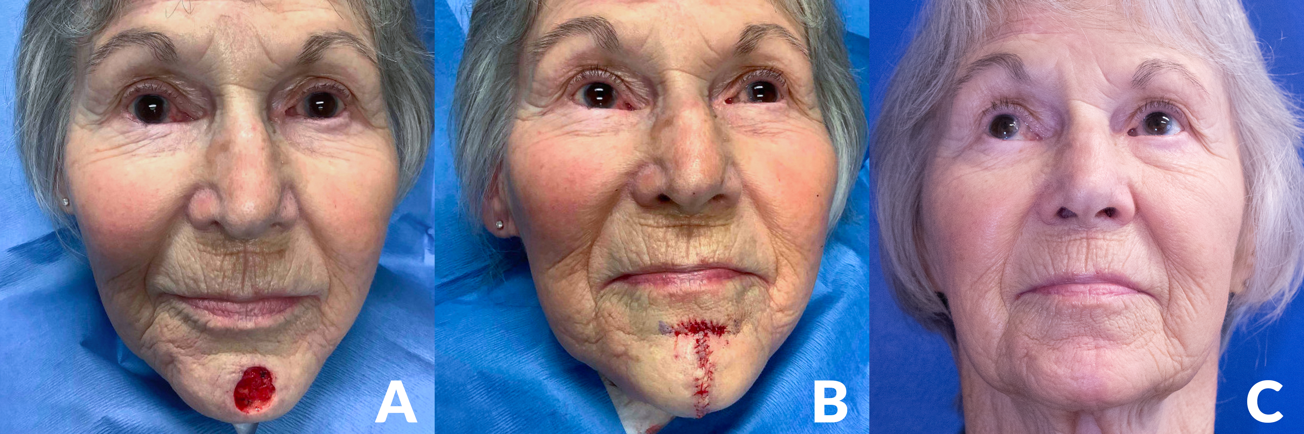 A surgical patient with three images, showing the progression of their skin cancer surgery and reconstruction