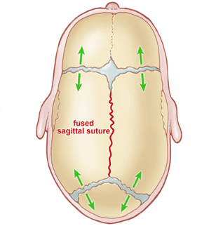 squamous suture