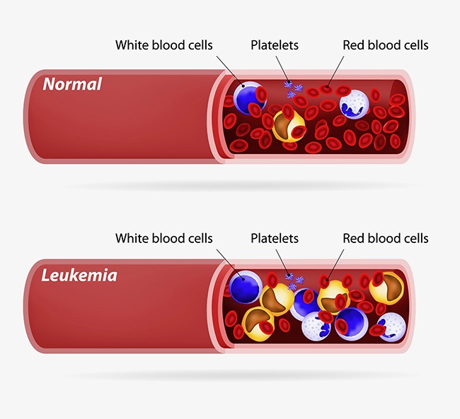 leukemia blood