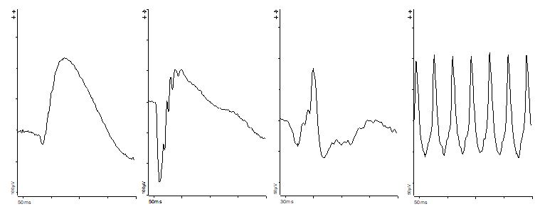 Four graphs in a horizontal row showing eye measurements taken with a full-field ERG equipment