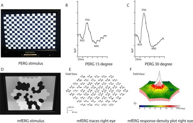 Six graphs stacked three on top and three underneath show the multifocal ARG test and the results that are recorded of the patient's vision.