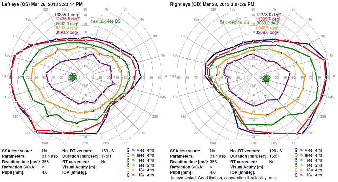 Two images of a patient's vision taken using perimetry testing.