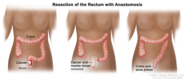 A three-panel drawing shows rectal cancer surgery with anastomosis. The first panel shows the area of rectum with cancer. The middle panel shows where that section of rectum and nearby tissue were removed. The last panel shows the colon and anus joined.