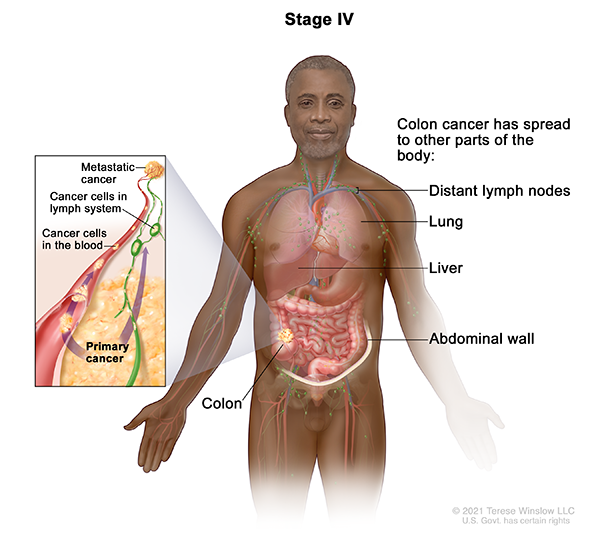 A drawing shows other parts of the body where colon cancer may spread, including the distant lymph nodes, lung, liver and abdominal wall. An inset shows cancer cells spreading from the colon, through the blood and lymph system, to another part of the body where cancer has formed.