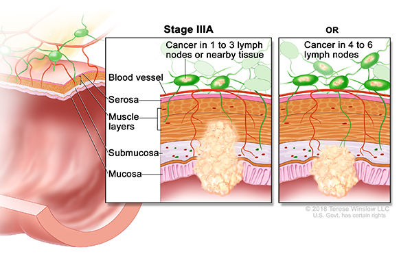 A drawing shows a cross-section of the colon and a two-panel inset. Each panel shows the layers of the colon wall: the mucosa, submucosa, muscle layers, and serosa. Also shown are a blood vessel and lymph nodes. The first panel shows cancer in the mucosa, submucosa, and muscle layers and in 2 lymph nodes. The second panel shows cancer in the mucosa and submucosa and in 5 lymph nodes.