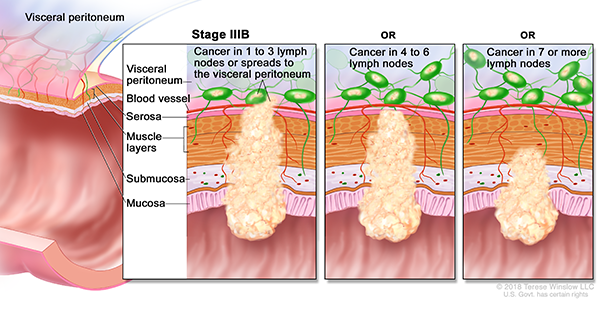 A drawing shows a cross-section of the colon and a three-panel inset. Each panel shows the layers of the colon wall: the mucosa, submucosa, muscle layers and serosa. Also shown are a blood vessel and lymph nodes. The first panel shows cancer in all layers, in 3 nearby lymph nodes, and in the visceral peritoneum. The second panel shows cancer in all layers and in 5 nearby lymph nodes. The third panel shows cancer in the mucosa, submucosa and muscle layers, and in 7 nearby lymph nodes.