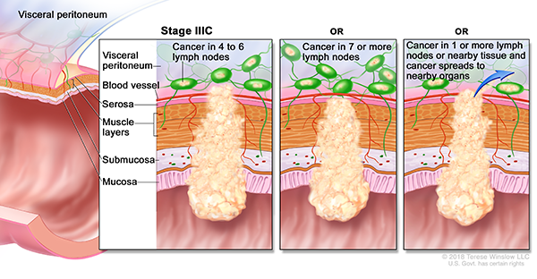 A drawing shows a cross-section of the colon and a three-panel inset. Each panel shows the layers of the colon wall: the mucosa, submucosa, muscle layers and serosa. Also shown are a blood vessel and lymph nodes. The first panel shows cancer in all layers, in 4 lymph nodes and in the visceral peritoneum. The second panel shows cancer in all layers and in 7 lymph nodes. The third panel shows cancer in all layers, in 2 lymph nodes, and spreading to nearby organs.