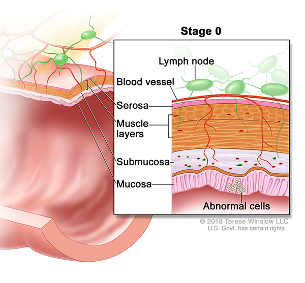 A drawing shows a cross-section of the colon. An inset shows the layers of the colon wall with abnormal cells in the mucosa layer. Also shown are the submucosa, muscle layers, serosa, a blood vessel and lymph nodes.