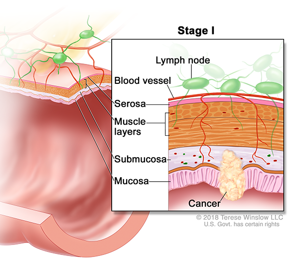A drawing shows a cross-section of the colon. An inset shows the layers of the colon wall with cancer in the mucosa and submucosa. Also shown are the muscle layers, serosa, a blood vessel, and lymph nodes.
