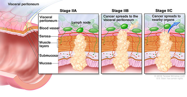 A drawing shows a cross-section of the colon and a three-panel inset. Each panel shows the layers of the colon wall: the mucosa, submucosa, muscle layers and serosa. The first panel shows stage IIA with cancer in the mucosa, submucosa, muscle layers and serosa. The second panel shows stage IIB with cancer in all layers and spreading through the serosa to the visceral peritoneum. The third panel shows stage IIC with cancer in all layers and spreading through the serosa to nearby organs.