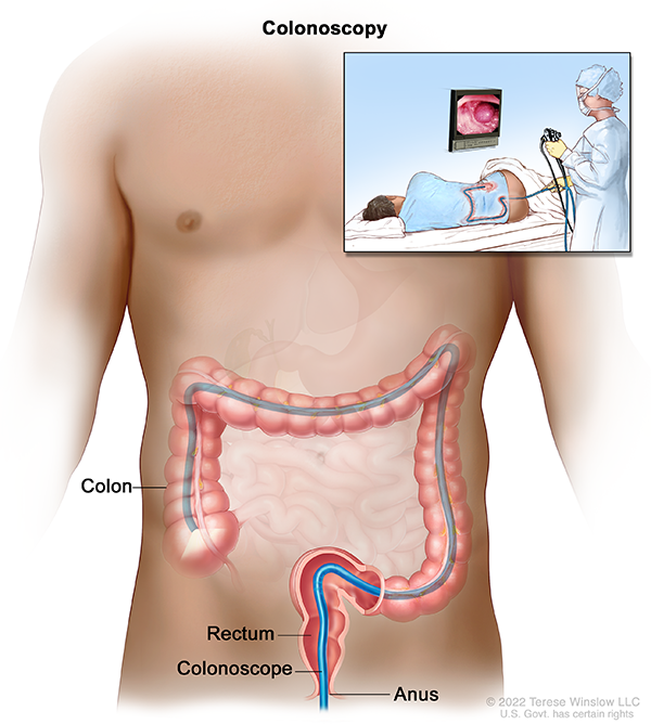 An illustration shows how a doctor guides a thin tube through the anus to inspect the rectum and colon. The sedated patient lies on their side.  The colon makes an upside-down U shape. The tube travels vertically up the colon, horizontally as the colon travels across the upper belly, and back down to the lower belly.