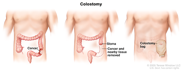 A three-panel drawing showing colon cancer surgery with colostomy. The first panel shows the area of the colon with cancer. The middle panel shows the cancer and nearby tissue removed and a stoma (opening) created. The last panel shows a colostomy bag attached to the stoma.