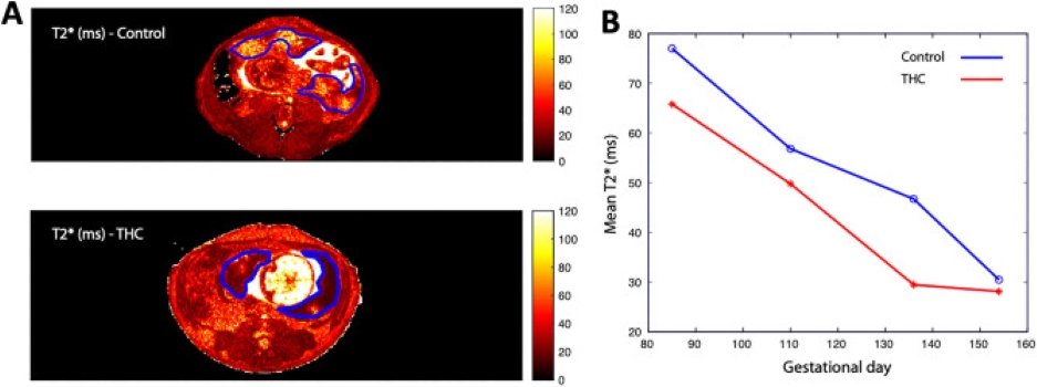 ROI outlines of placenta of rhesus macaque MRI scans of control and THC treated group subjects (A) and MRI T2star graphed, control and THC over gestational ages (B)