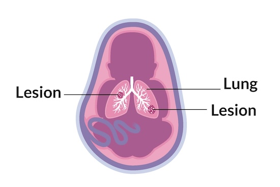 Lung lesions can form while a fetus is in the uterus, and may be seen in an ultrasound.