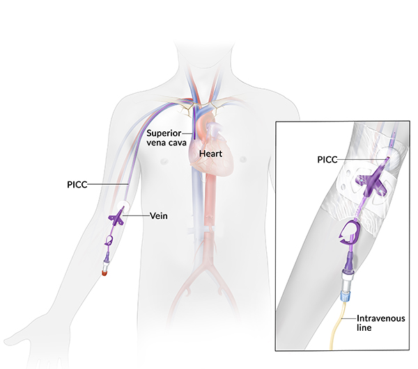 Peripherally inserted central catheter: An illustration of a peripherally inserted central catheter shows a long flexible tube inserted in the arm. The tube extends into the superior vena cava, a vein that leads to the heart.  An inset illustration shows a close-up of the catheter where it is inserted in the arm, and its attached intravenous line. 