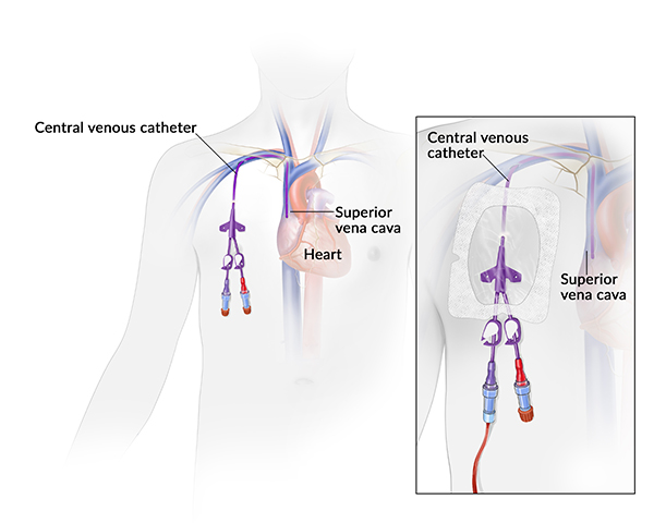 Central venous catheter: An illustration of a central venous catheter shows a long flexible tube inserted in the superior vena cava, a vein that leads to the heart.  An inset illustration shows a closeup of the catheter taped to the chest. 