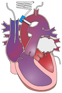 A diagram showing the anatomy of the hypoplastic left heart model in fetal sheep