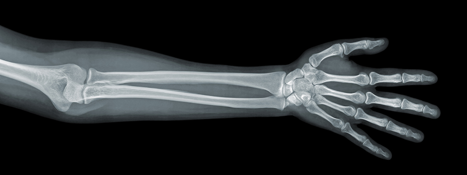 An X-ray of a hand, forearm and part of the upper arm.