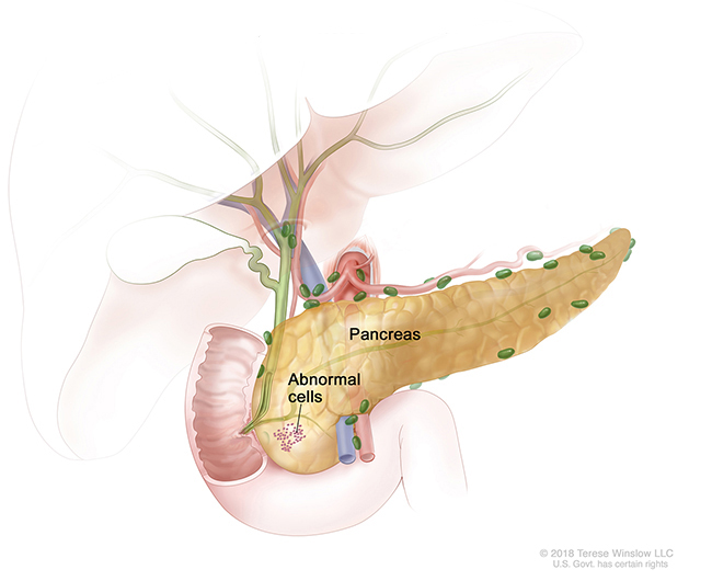 A drawing of stage 0 pancreatic cancer shows abnormal cells in the pancreas.