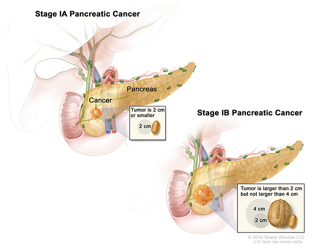 A drawing of stage 1A pancreatic cancer shows a 2-centimeter tumor in the pancreas. An inset shows that 2 centimeters is about the size of a peanut. A drawing of stage 1B pancreatic cancer shows a tumor between 2 and 4 centimeters in the pancreas. An inset shows that 2 centimeters is about the size of a peanut and 4 centimeters is about the size of a walnut.