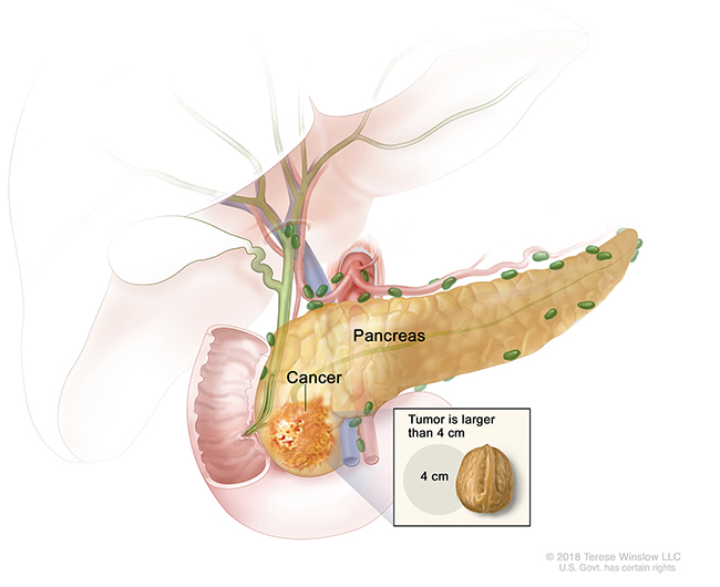 A drawing shows a tumor larger than 4 centimeters in the pancreas. An inset shows 4 centimeters is about the size of a walnut.