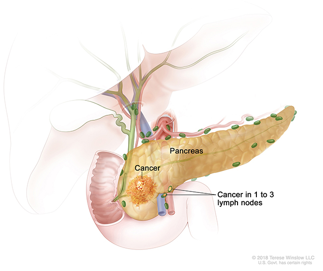 A drawing shows cancer in the pancreas and in one to three nearby lymph nodes.