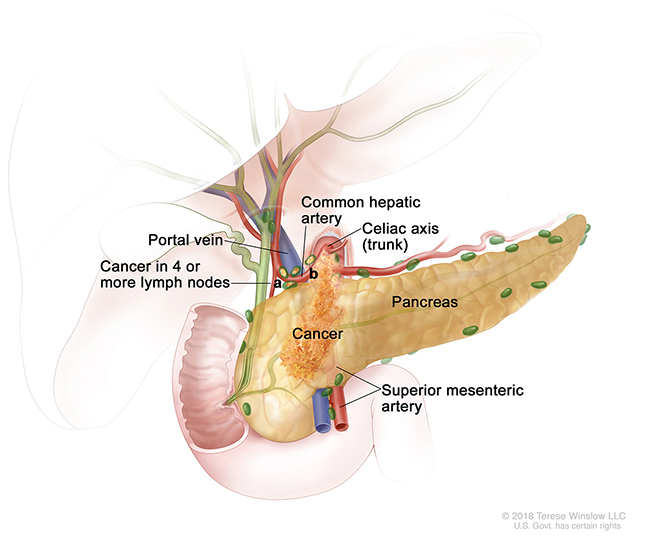 A drawing shows cancer in the pancreas, in nearby lymph nodes and in an artery.