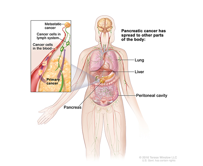 A drawing shows how pancreatic cancer may spread to other body parts, including the lung and liver. An inset shows cancer cells spreading from the pancreas through the blood and lymph system to another part of the body.