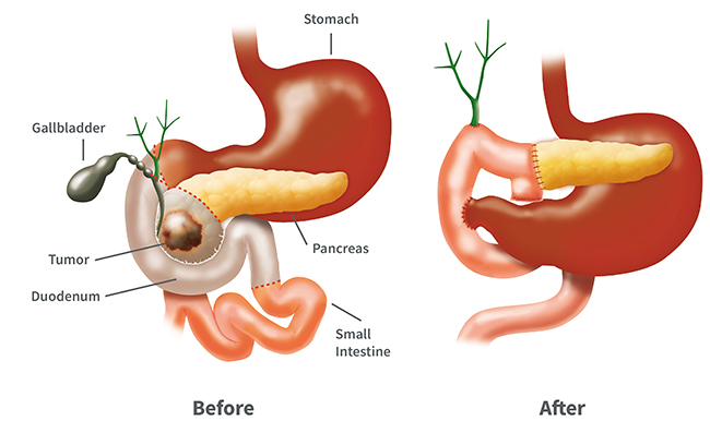 A drawing shows part of the digestive system before and after the Whipple procedure. The “after” drawing shows that surgery removed the tumor, part of the pancreas, the top part of the small intestine, the gallbladder and parts of the stomach. The small intestine is reconnected to the stomach.