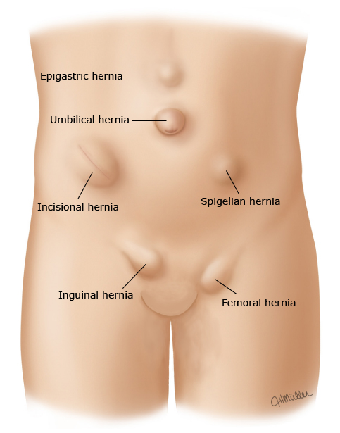 An illustration showing the different hernia types, from top to bottom: epigastic, umbilical, incisional, spigelian, inguinal and femoral.