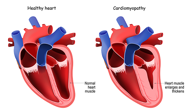 An illustration of a heart shows where HCM can enlarge and thicken the heart muscle.